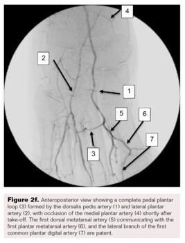 Pedal-Plantar Loop in Lower Extremity Angiographic Interventions Fig2f
