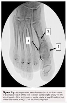 Pedal-Plantar Loop in Lower Extremity Angiographic Interventions Fig2g