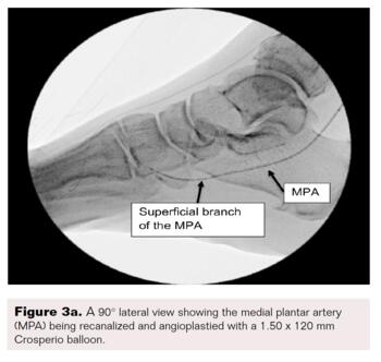 Pedal-Plantar Loop in Lower Extremity Angiographic Interventions Fig3a