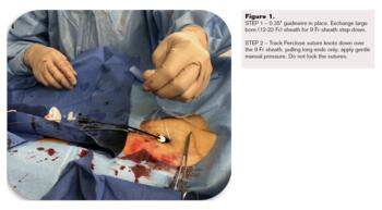 Controlled Step-Down Access Closure for Large Bore Access. Fig1