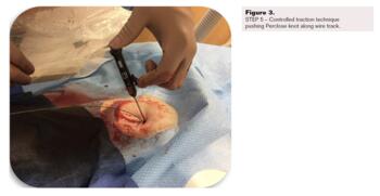 Controlled Step-Down Access Closure for Large Bore Access Fig3