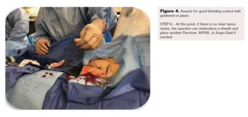 Controlled Step-Down Access Closure for Large Bore Access Fig4