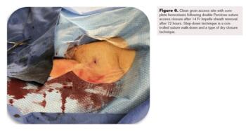 Controlled Step-Down Access Closure for Large Bore Access Fig6