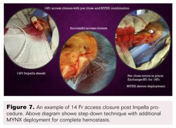Controlled Step-Down Access Closure for Large Bore Access Fig7
