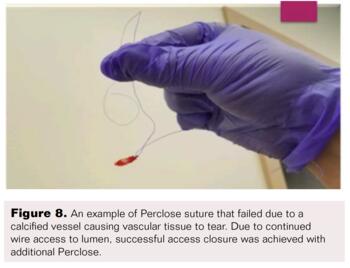 Controlled Step-Down Access Closure for Large Bore Access Fig8