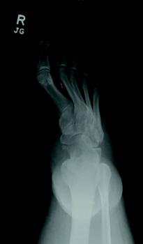 In the above images, one can see non-weight-bearing right foot radiographs prior to the onset of an acute Charcot event. Charcot neuroarthropathy is a tissue-destructive process of the musculoskeletal system in patients with neuropathy.6-9