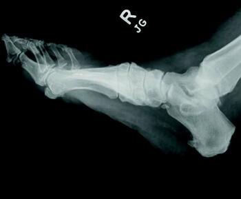 In the above images, one can see non-weight-bearing right foot radiographs prior to the onset of an acute Charcot event. Charcot neuroarthropathy is a tissue-destructive process of the musculoskeletal system in patients with neuropathy.6-9