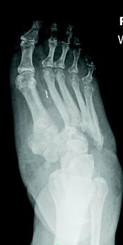 The above image shows a weightbearing right foot radiograph of the same foot seen prior following an acute Charcot event. Note the extensive joint collapse at the tarsometatarsal and naviculocuneiform joints with subsequent midfoot and hindfoot instability.
