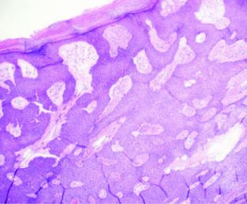 Histologic exam, as seen in this image, included findings of “small, duct-like laminae … within sheets of neoplastic cells.”