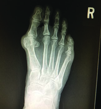 This radiograph shows a medial shift of the second toe associated with a plantar plate injury. Note the hallux valgus deformity and relatively long second metatarsal.