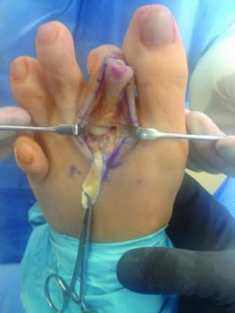 In this intraoperative photograph, one can see a significant medial shift of the proximal phalanx associated with a plantar plate injury.