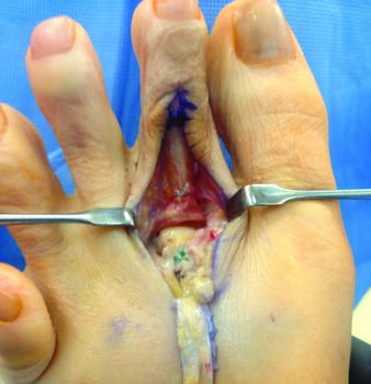 This image shows a corrected plantar plate deformity with hammertoe fusion, metatarsal osteotomy, and primary plantar plate ligament repair of the lateral aspect only.