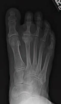 This radiographic image shows degeneration of the second metatarsophalangeal joint (MPJ). Procedures to address arthritic pain at the second MPJ typically fall into two categories, either joint sparing or joint destructive.