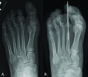 These radiographs show views before (left) and after (right) an isolated singular metatarsal head resection. In the authors’ experience, this procedure is usually a last resort due to concerns for development of adjunctive pathologies.