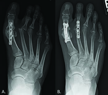 The authors say surgeons may choose to perform adjacent first MPJ arthrodesis (left) in younger patients that require second MPJ arthrodesis (right), to shield the lesser MPJ from excessive weight-bearing stress and premature hardware failure.