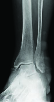 This X-ray shows a moderately displaced unimalleolar ankle fracture. Understanding normal ankle joint biomechanics is key in surgical planning. Photo courtesy of Mark Prissel, DPM