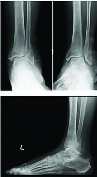 If appropriate, early weight-bearing of post-ORIF might expedite an earlier return to work, subsequently minimizing the economic impact of fractures and lessening altered gait mechanics. Photos courtesy of Mark Prissel, DPM.