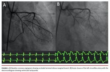 Baseline coronary angiogram showing occluded terminal obtuse marginal branch.