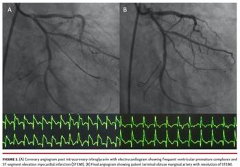 Coronary angiogram post intracoronary nitroglycerin with electrocardiogram showing frequent ventricular premature complexes and ST-segment elevation myocardial infarction