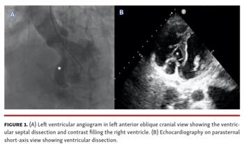 Left ventricular angiogram in left anterior oblique cranial & echocardiography on parasternal short-axis view