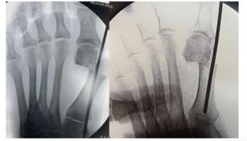This image shows advancement of a wire intramedullary to the metatarsal base or across the first TMTJ for additional stability.