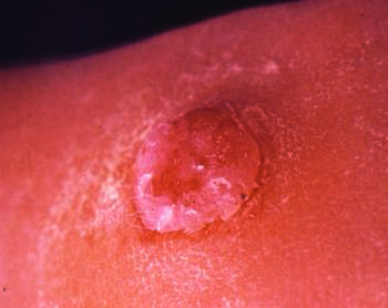 Eccrine poroma, as seen in this photo, may have a clinically deceiving appearance. Diagnostic testing is advisable to avoid incorrect treatment. Photo courtesy of James Del Rosso, DO.