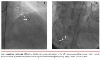 Endothelial Progenitor Cell Function in Coronary CTO Patients Fig S1