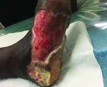 Reports note increasing amputation rates as a consequence of the disruption in care of those with diabetic foot wounds, creating a “pandemic within a pandemic.” Photo courtesy of Ryan Fitzgerald, DPM.