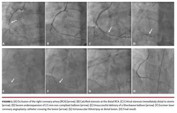 Photo showing Occlusion of the right coronary artery