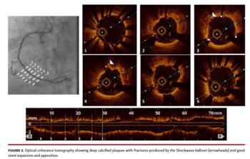 Optical coherence tomography showing deep calcified plaques with fractures produced by the Shockwave balloon