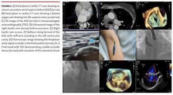 Axial plane in cardiac CT scan showing an ostium secundum atrial septum defect