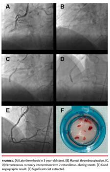 Photo showing Late thrombosis in 3-year-old stent, Manual thromboaspiration, Percutaneous coronary intervention with 2 zotarolimus-eluting stents, Good angiographic result, Significant clot extracted.