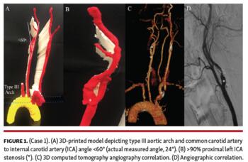 Case 1 3D-printed model depicting type III aortic arch and common carotid artery to internal carotid artery