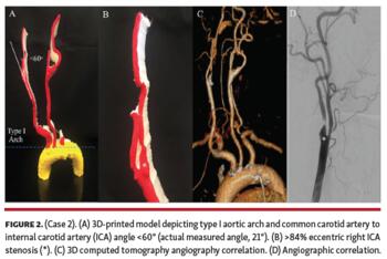 Case 2 3D-printed model depicting type I aortic arch and common carotid artery to internal carotid artery