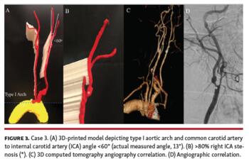 Case 3 3D-printed model depicting type I aortic arch and common carotid artery to internal carotid artery