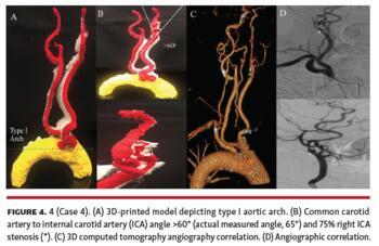 Case 4 3D-printed model depicting type I aortic arch