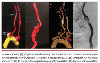 Case 5 3D-printed model depicting type III aortic arch and common carotid artery to internal carotid artery