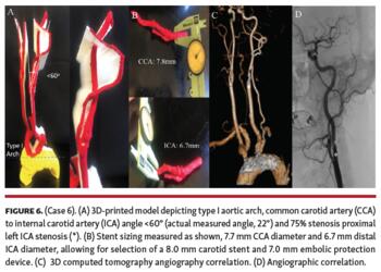 Case 6  3D-printed model depicting type I aortic arch, common carotid artery (CCA) to internal carotid artery