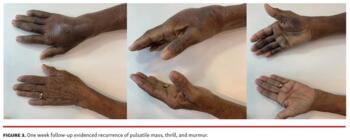 One week follow-up evidenced recurrence of pulsatile mass, thrill, and murmur.