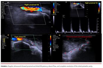 Doppler ultrasound showed proximal and distal RA patency, absent flow, and complete resolution of the initial pulsatile cavity.
