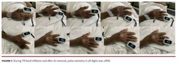 During TR band inflation and after its removal, pulse oximetry in all digits was ≥95%.
