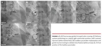 Fluoroscopy-guided tricuspid valve crossing.