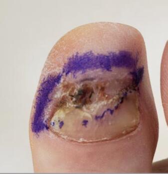 A 66-year-old female presented to the office with what appeared to be a pyogenic granuloma to the dorsal distal aspect of the right hallux.