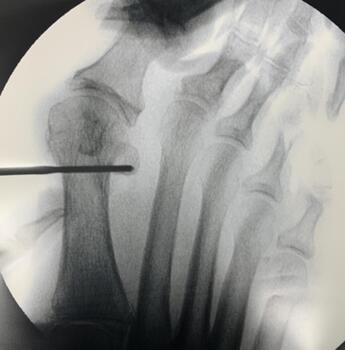 This image shows a direct drill hole, straight through the medial and lateral cortex of the first metatarsal neck.