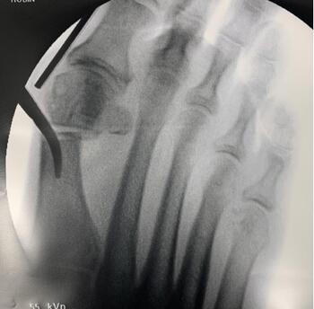 This photo shows the insertion of an elevator or hemostat into the medullary canal.