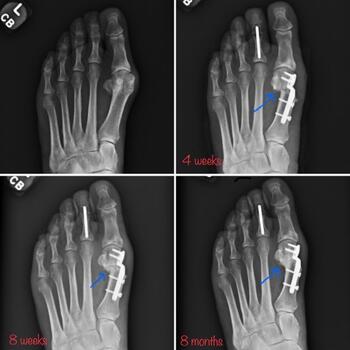 These images show consolidation of the gap between the lateral metatarsal head and metatarsal shaft over time.