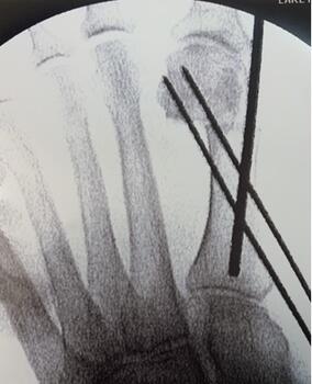 The authors recommend surgeons be cognizant of maximum screw length to help in planning of wire trajectory.