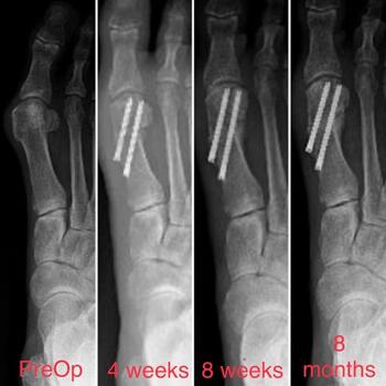 These images show postop progress after MIS bunion surgery.