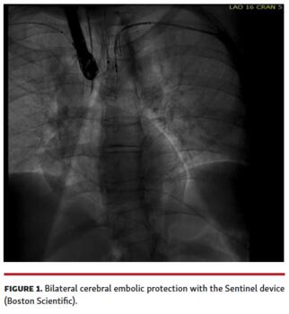 Figure showing bilateral cerebral embolic protection with the Sentinel device 