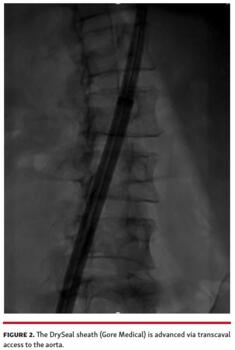 Figure showing the DrySeal sheath (Gore Medical) is advanced via transcaval access to the aorta.